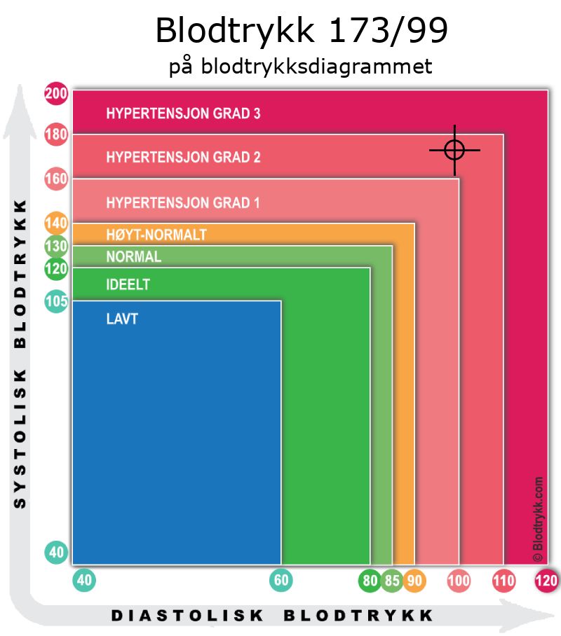 Blodtrykk 173 over 99 på blodtrykksdiagram