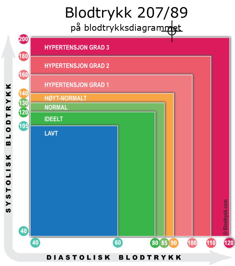 Blodtrykk 207 over 89 på blodtrykksdiagram